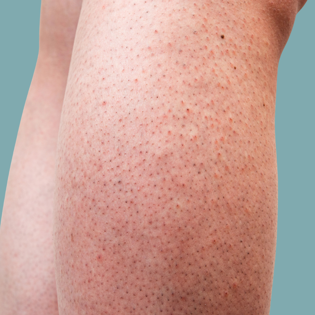 strawberry legs