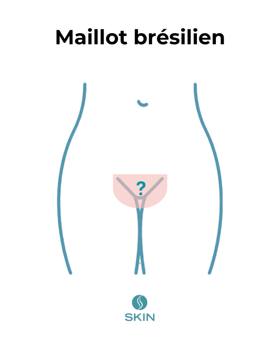 épilation laser maillot brésilien
