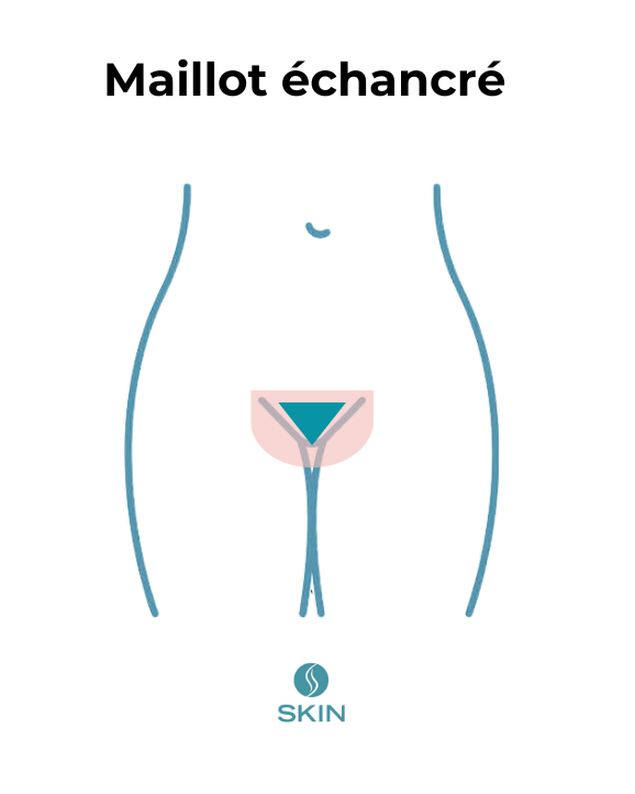épilation laser maillot échancré