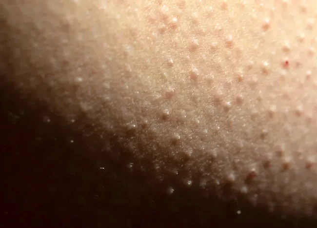 Peau kératose pilaire