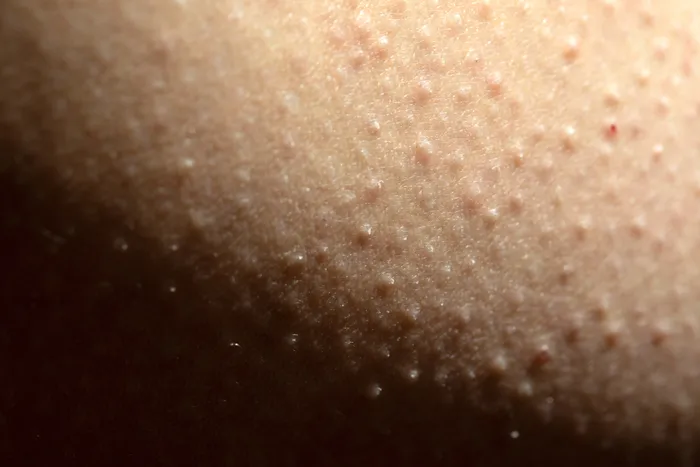 Peau kératose pilaire